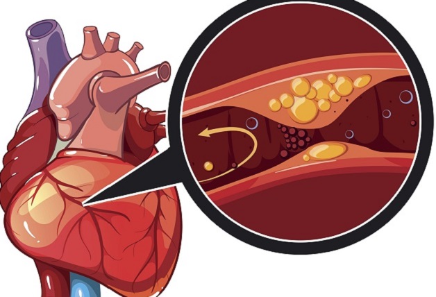 Huyết khối có thể gây tắc nghẽn hoặc giảm lưu lượng máu đến cơ tim