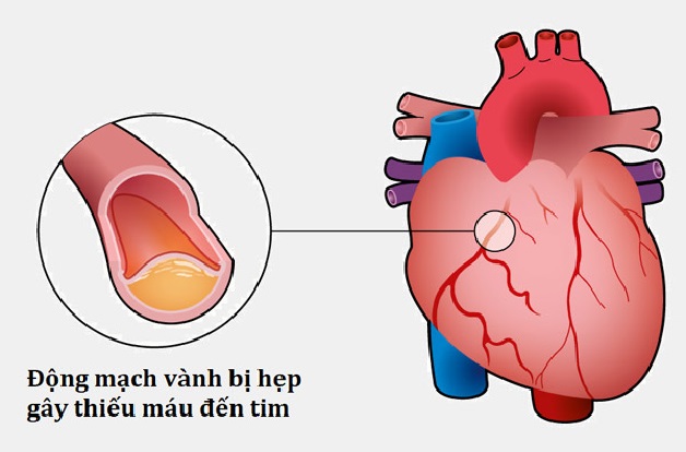 Xơ vữa động mạch vành là một trong những nguyên nhân thiếu máu cơ tim phổ biến nhất