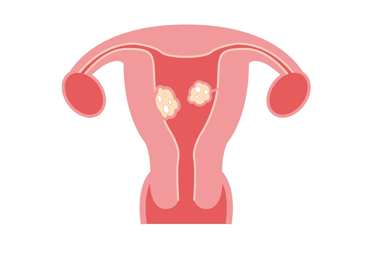 Hình ảnh minh họa nhân xơ tử cung trong buồng tử cung