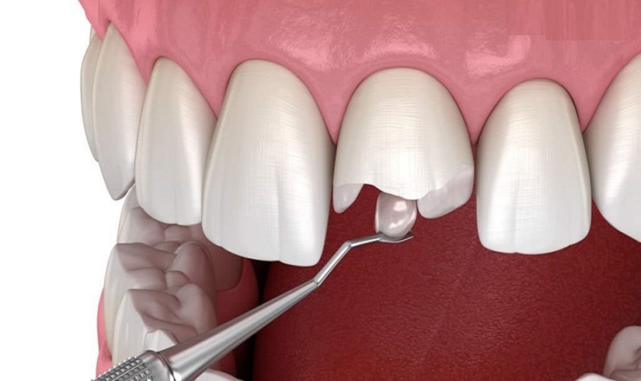 Làm thế nào để ngăn ngừa răng cửa bị sâu nặng?
