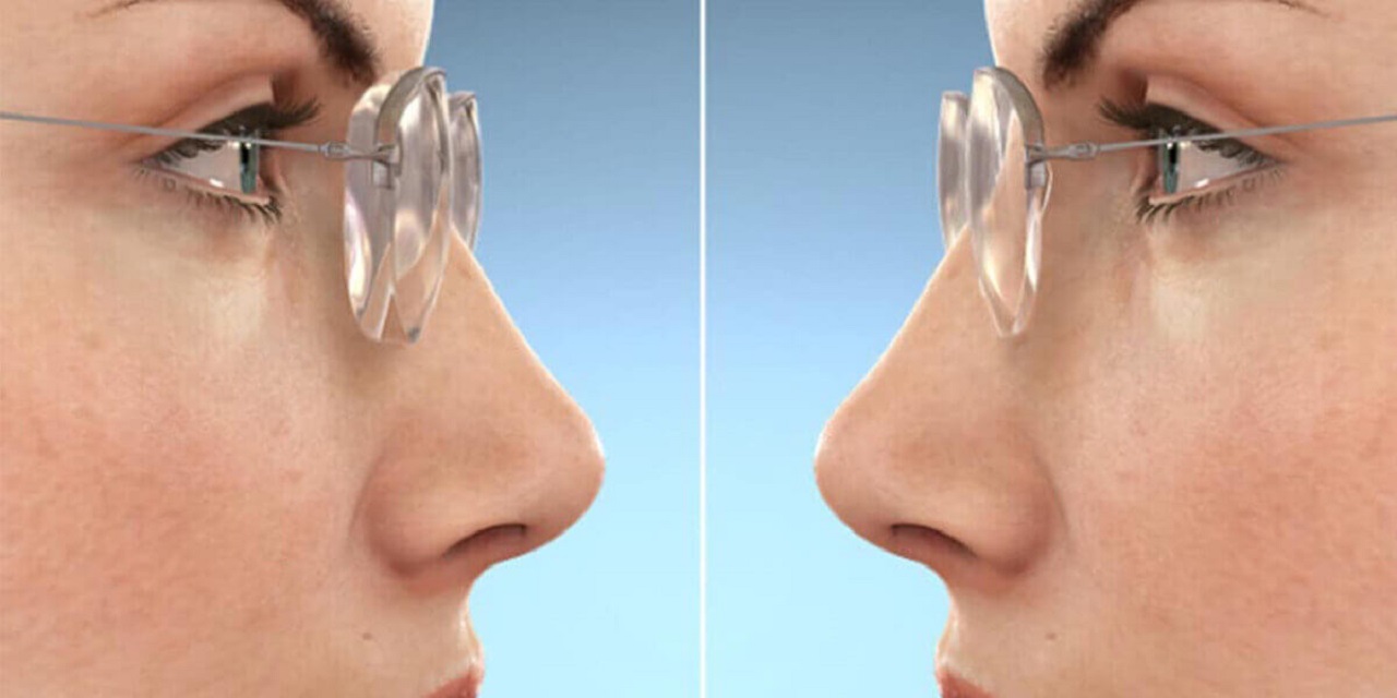 Mắt kính cận mỏng có thể giúp giảm được tỷ lệ lưỡi kính không?
