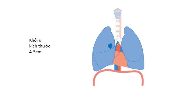 Điều trị bệnh ung thư phổi không tế bào nhỏ giai đoạn 2