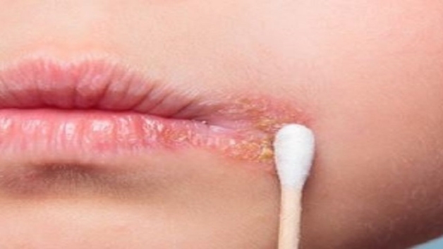 Bệnh Herpes Có Chữa Khỏi Được Không? Tìm Hiểu Các Giải Pháp Hiệu Quả