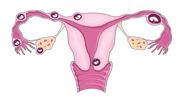 Mang thai ngoài tử cung thường không có dấu hiệu cụ thể, rõ ràng