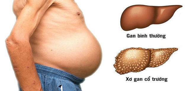 Cổ trướng là biến chứng sau mổ cắt gan nguy hiểm