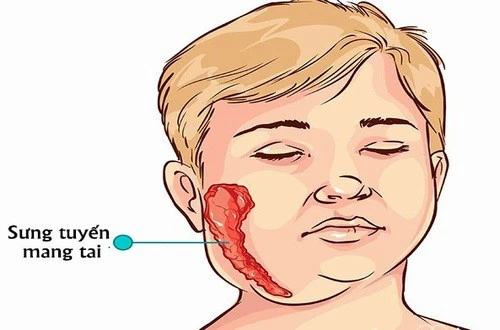 Bệnh Quai Bị Ở Bé Trai: Nguyên Nhân, Triệu Chứng và Cách Phòng Ngừa