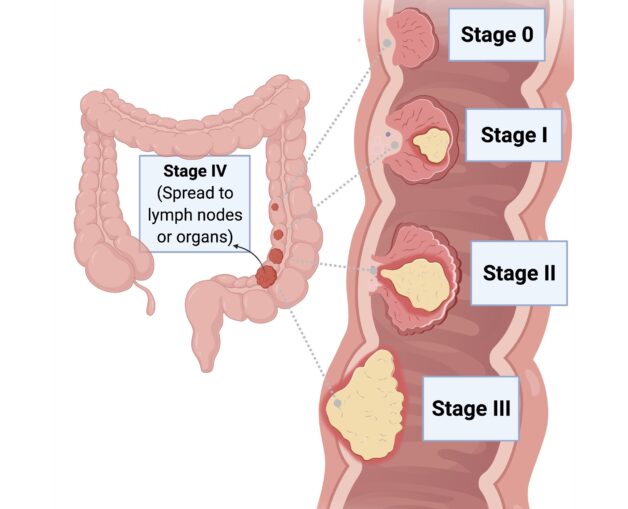 Cách điều trị bệnh ung thư đại tràng theo mỗi giai đoạn