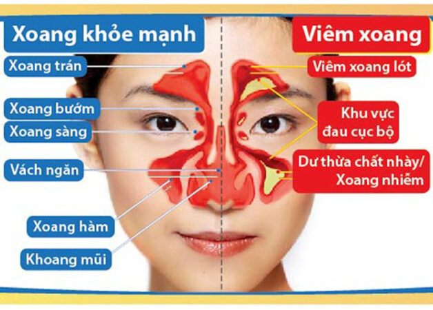 Cách chữa viêm xoang mãn tính: Phương pháp điều trị hiệu quả và phòng ngừa biến chứng