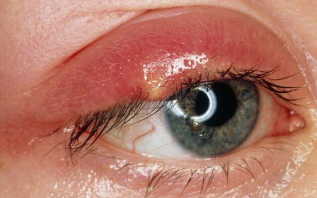 Dấu hiệu bệnh lý có thể gặp phải khi bị đỏ mắt
