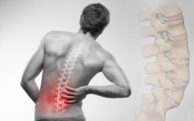 Thoát vị đĩa đệm biểu hiện là các cơn đau lưng