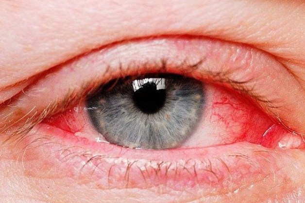 đau mắt đỏ