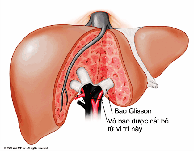 Nội Soi Gan: Phương Pháp Hiệu Quả Giúp Điều Trị Và Phục Hồi Nhanh