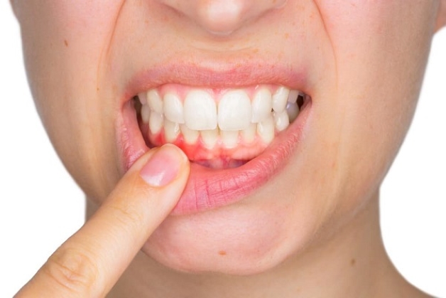 nổi mụn trắng ở nướu răng
