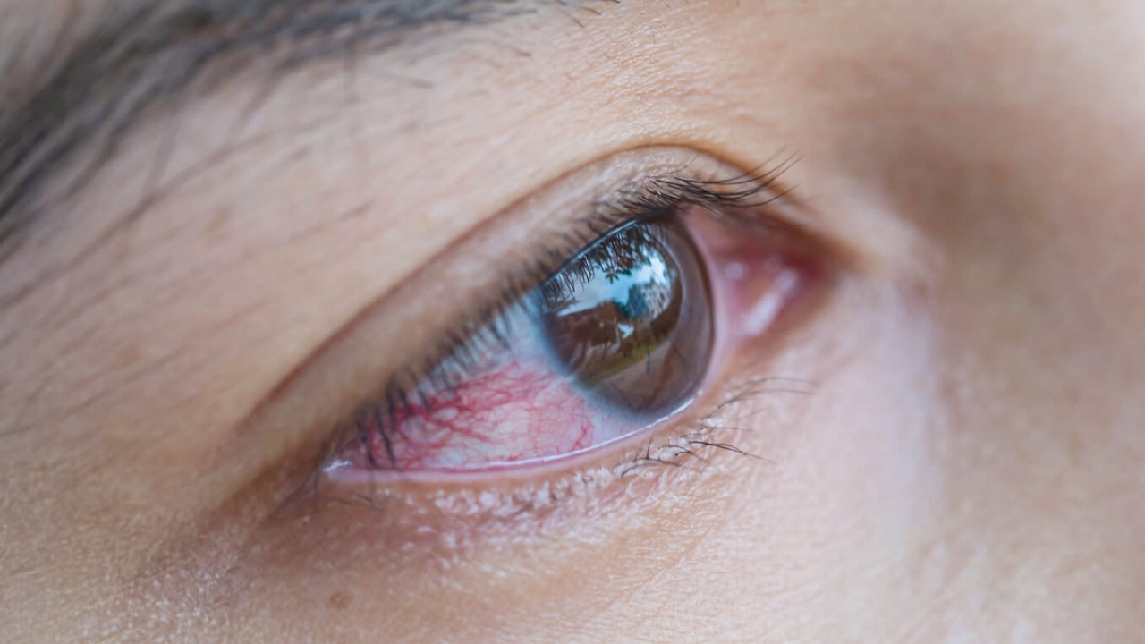 Tất tần tật những điều cần biết về bệnh glocom mắt