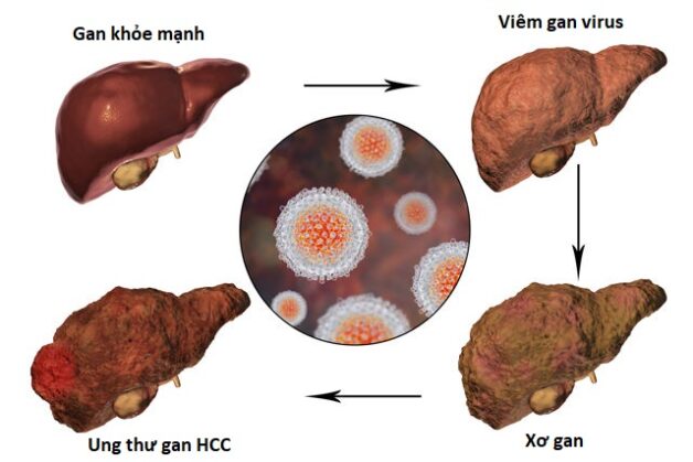 Ung thư biểu mô tế bào gan (HCC) là gì?