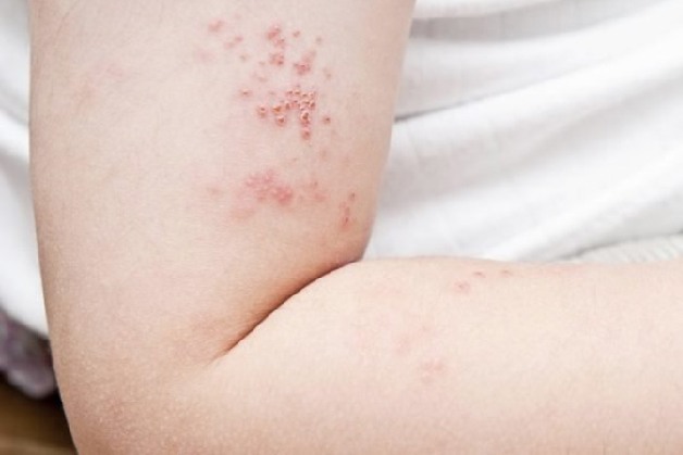 Bệnh Zona sẽ biểu hiện bằng những tổn thương da là những mảng phát ban gây đau phân bổ rải rác trên khắp cơ thể