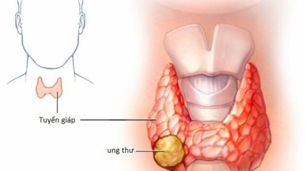 Nhu mô tuyến giáp không đều: Nguyên nhân, triệu chứng và phương pháp điều trị