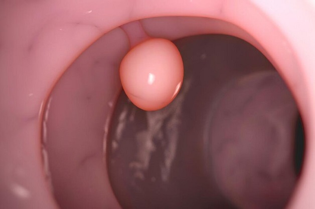 viem dai trang polyp 1