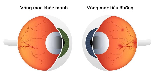 Võng mạc tiểu đường: Cách chẩn đoán và điều trị