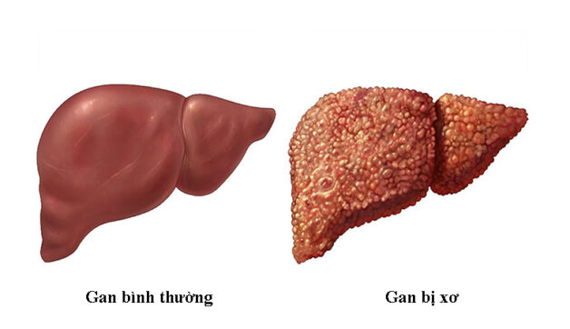 3. Điều trị bệnh xơ gan theo nguyên nhân