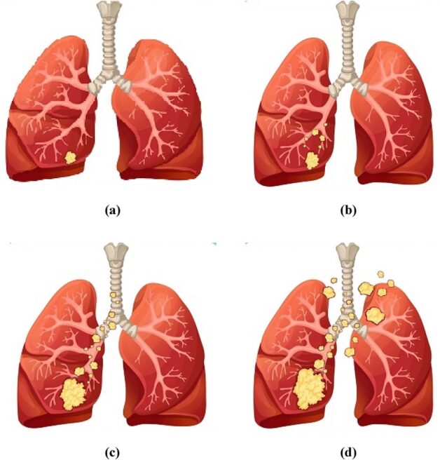Tìm hiểu cách trị ung thư phổi theo giai đoạn bệnh