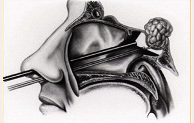 Phẫu thuật u tuyến yên qua nội soi mũi
