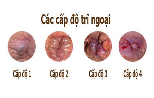 Trĩ Ngoại Cấp Độ 2: Triệu Chứng và Cách Điều Trị Hiệu Quả