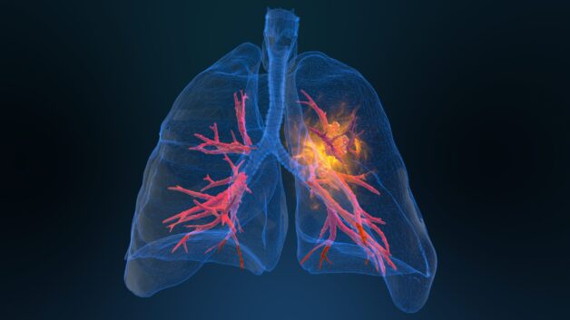 Tìm hiểu cách điều trị bệnh ung thư phổi giai đoạn 1