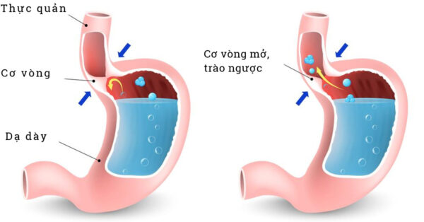 4. Cách phòng ngừa hôi miệng do hở van dạ dày