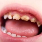 Những điều cần biết về cao răng ở trẻ em