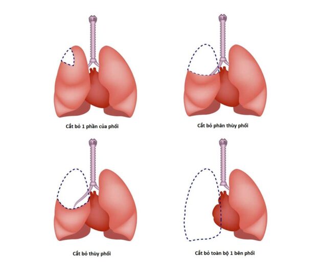 Cách chữa ung thư phổi không tế bào nhỏ theo giai đoạn