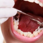 Sự phát triển của quá trình sâu răng