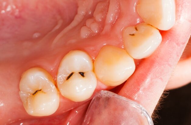 Theo thống kê của Bộ Y tế, tại Việt Nam, hơn 80% cư dân có bệnh lý sâu răng. 