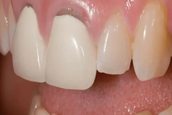 răng sứ rớt ra