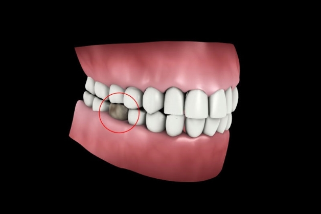 sâu răng số 5