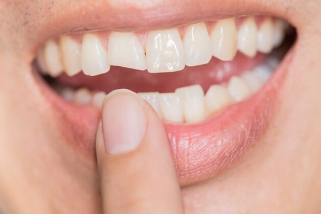 Mẻ răng là tình trạng mất một phần răng (có thể to hoặc nhỏ), phát sinh chủ yếu do răng phải chịu tác động vật lý.