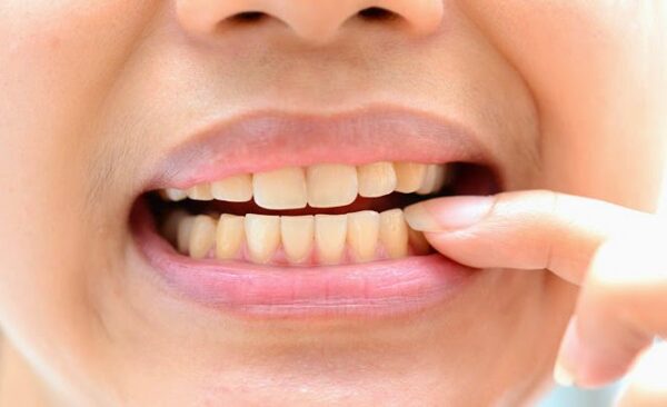 Cặn vôi răng tạo ra môi trường thuận lợi cho vi khuẩn gây hại phát triển