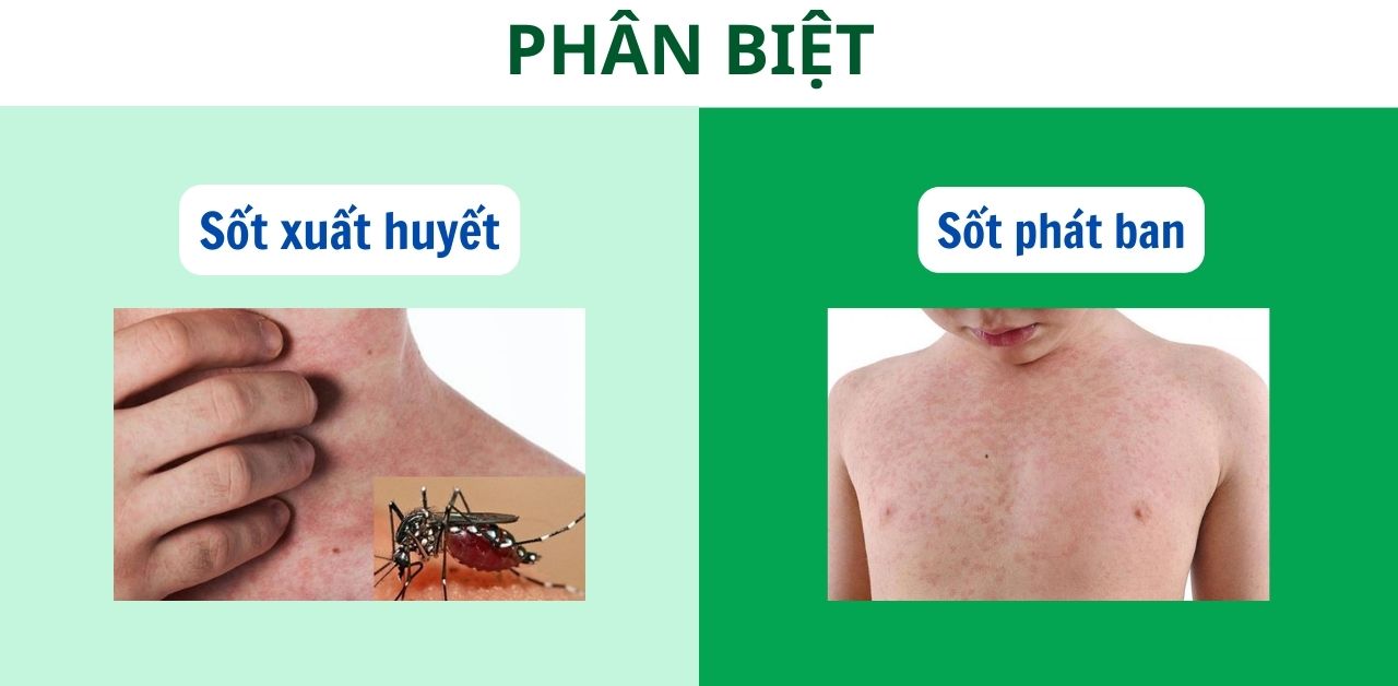 4. Cách nhận biết phát ban sau khi sốt xuất huyết