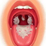 Con đường lây nhiễm của bệnh bạch hầu bạn cần biết