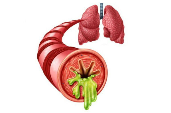 7. Những biến chứng nguy hiểm của viêm phế quản mãn tính