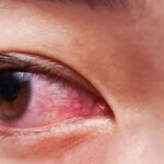 3 Cách chữa đau mắt đỏ cho bà bầu hiệu quả, an toàn