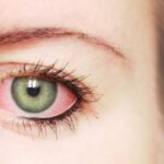 Dấu hiệu đau mắt đỏ khi mang thai – Mẹ bầu cần lưu ý