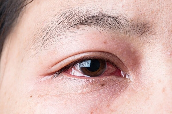 Hầu hết các bệnh về mắt bao gồm đau mắt đỏ đều không gây ảnh hưởng đến sự phát triển của thai nhi