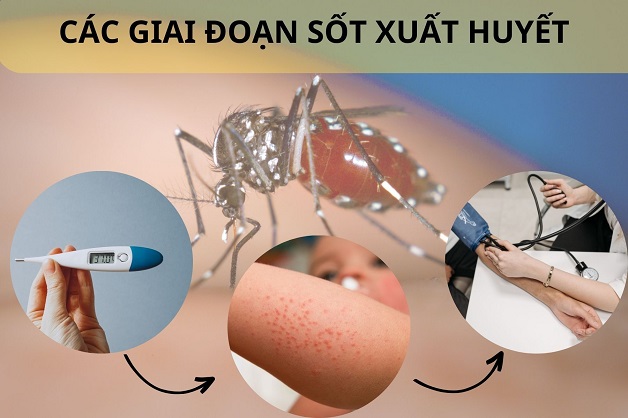 3 Giai Đoạn Của Sốt Xuất Huyết: Diễn Biến, Triệu Chứng và Lời Khuyên