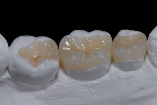 Điểm nổi bật của dịch vụ hàn răng Inlay Onlay là gì?