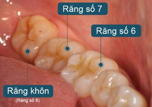 7. Chăm sóc sau khi nhổ răng khôn