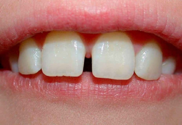 răng nhọn mọc giữa 2 răng cửa