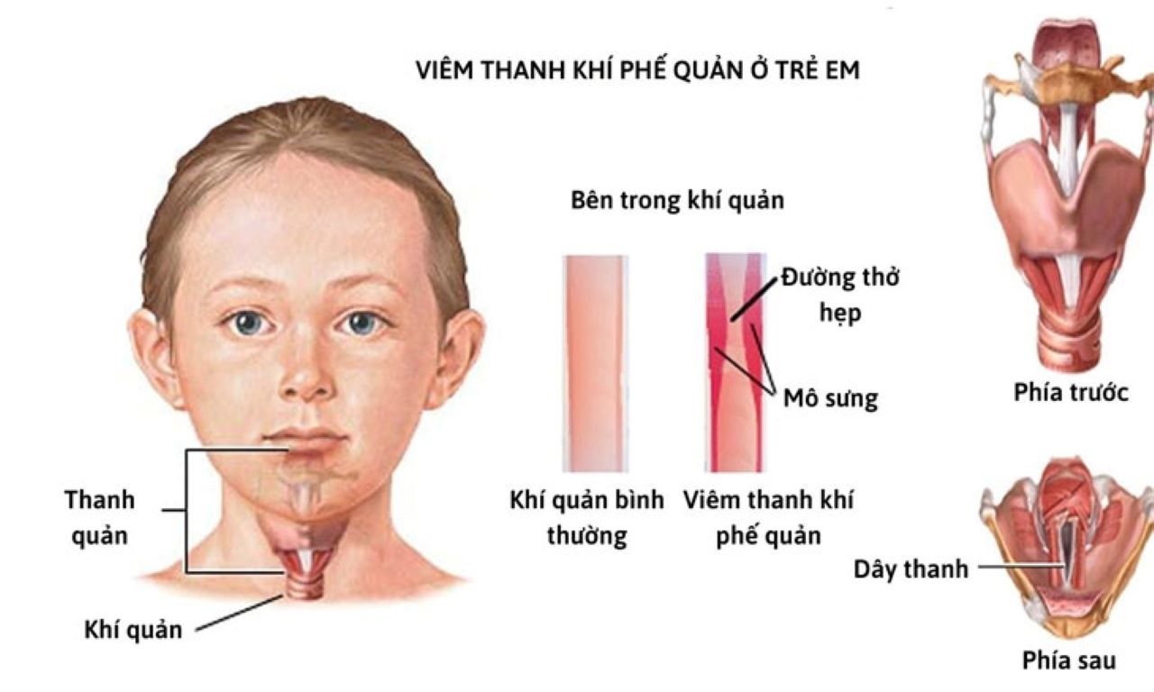 Phác Đồ Điều Trị Viêm Thanh Quản Ở Trẻ Em Hiệu Quả Và An Toàn