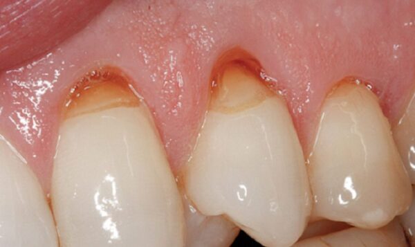 Tìm hiểu về trám mòn cổ răng là gì?