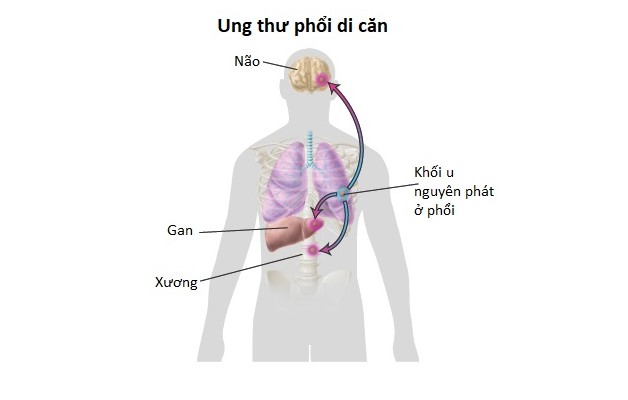 Thông tin về điều trị ung thư gan thứ phát